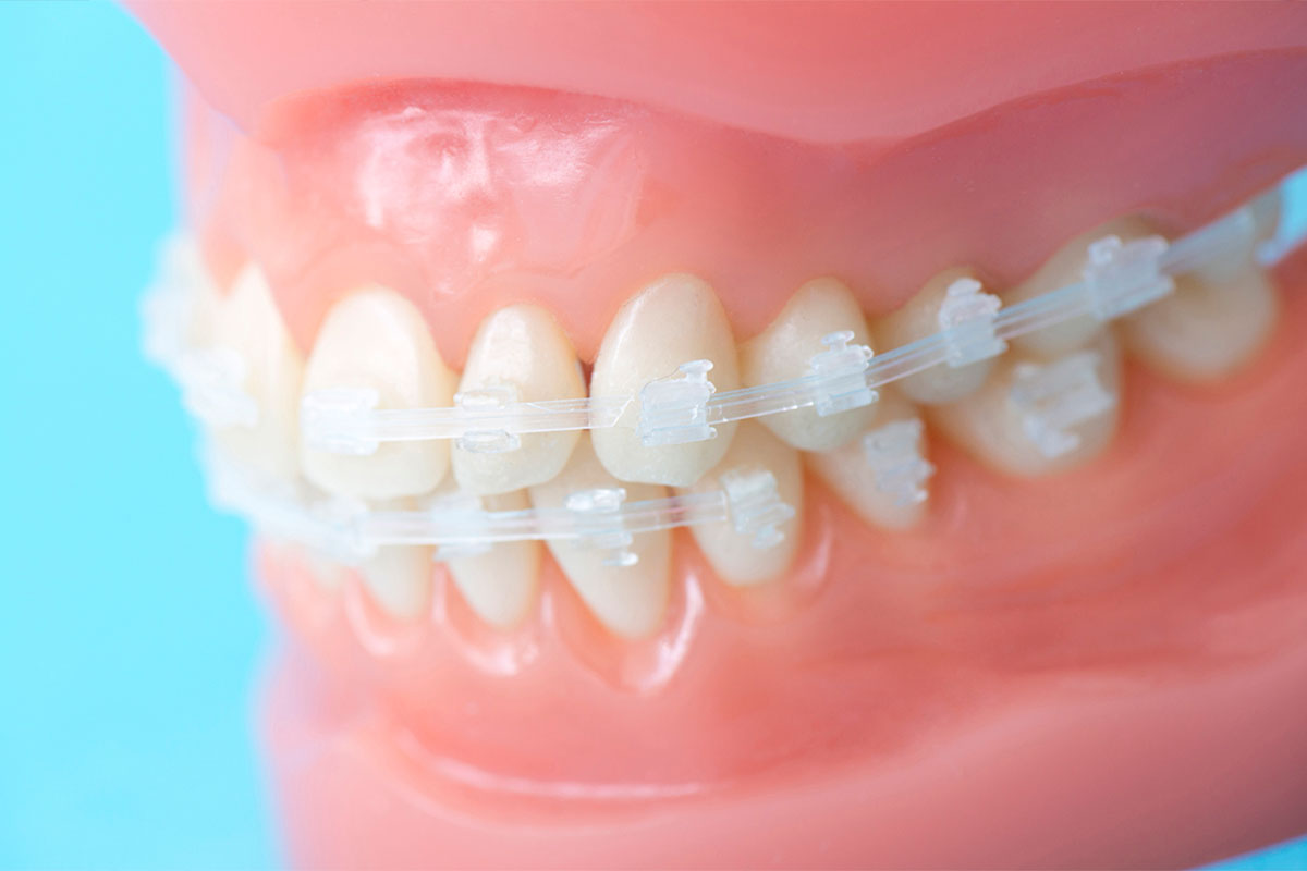 セラミックブラケット